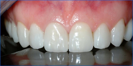 Porcelain veneers, bonded.